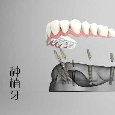 安徽合肥种植牙价格表，人工种植牙价钱